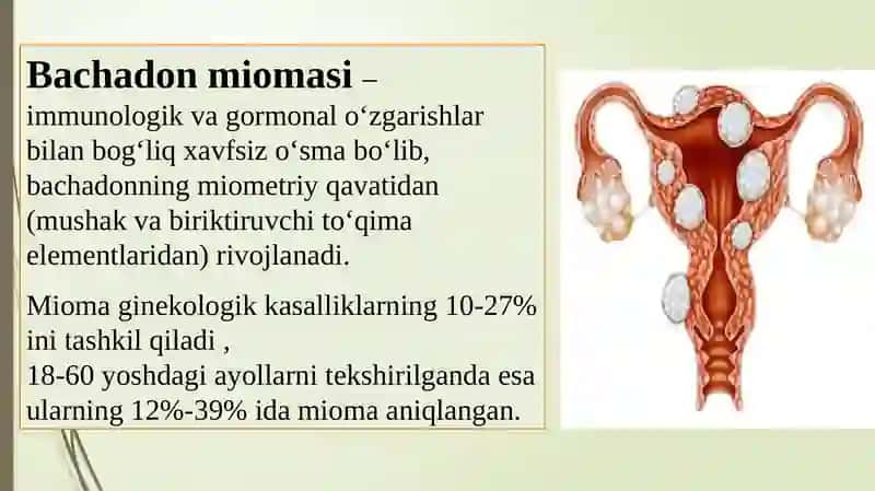 Bachadon miomasi. Endometrioz. 2