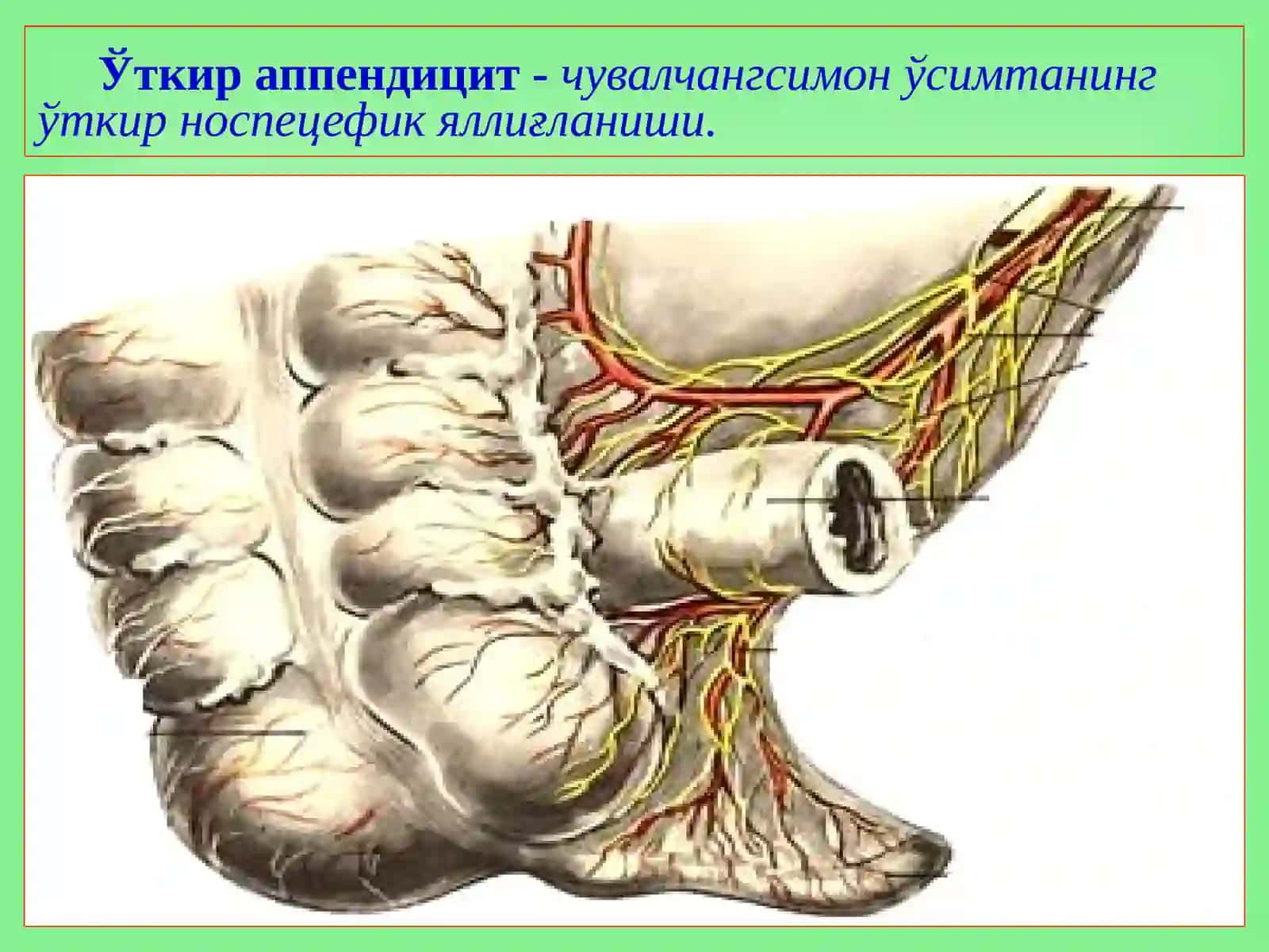Аппендицит асоратлари 2