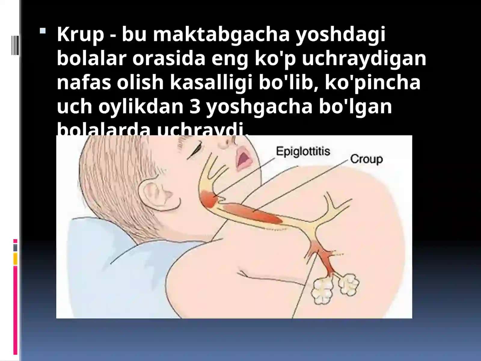 Krupsindromi 2