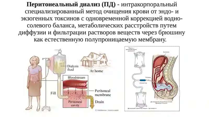 Перитонеальный диализ 2