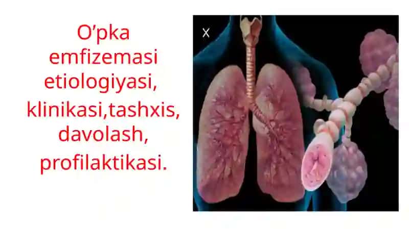 O’PKA EMFIZEMASI 2