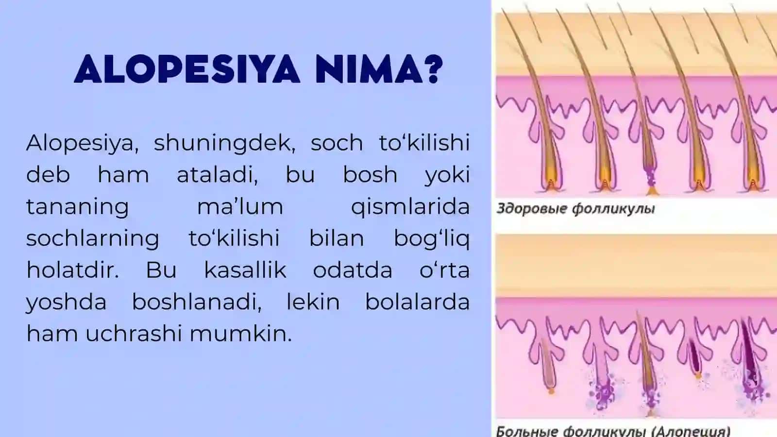 ALOPESIYANING ZAMONAVIY DAVOLASH USULLARI 2