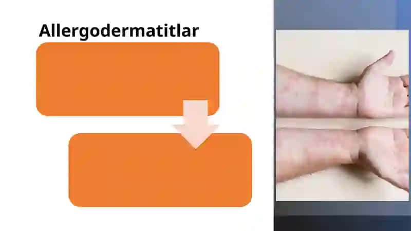 Allergodermatitlar 2