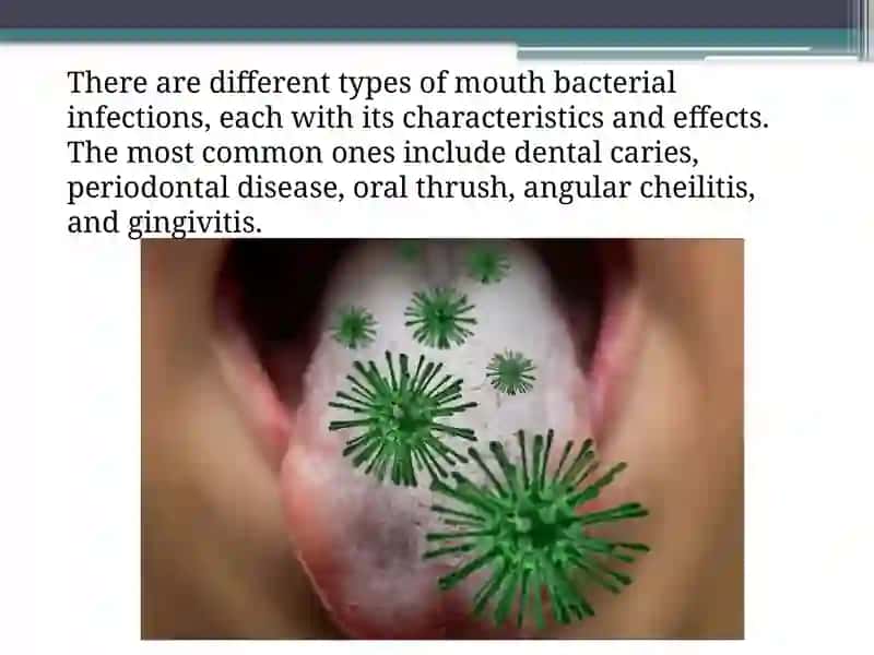 Oral cavity infections 2