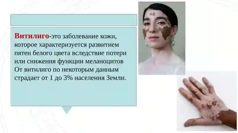 Витилиго 2