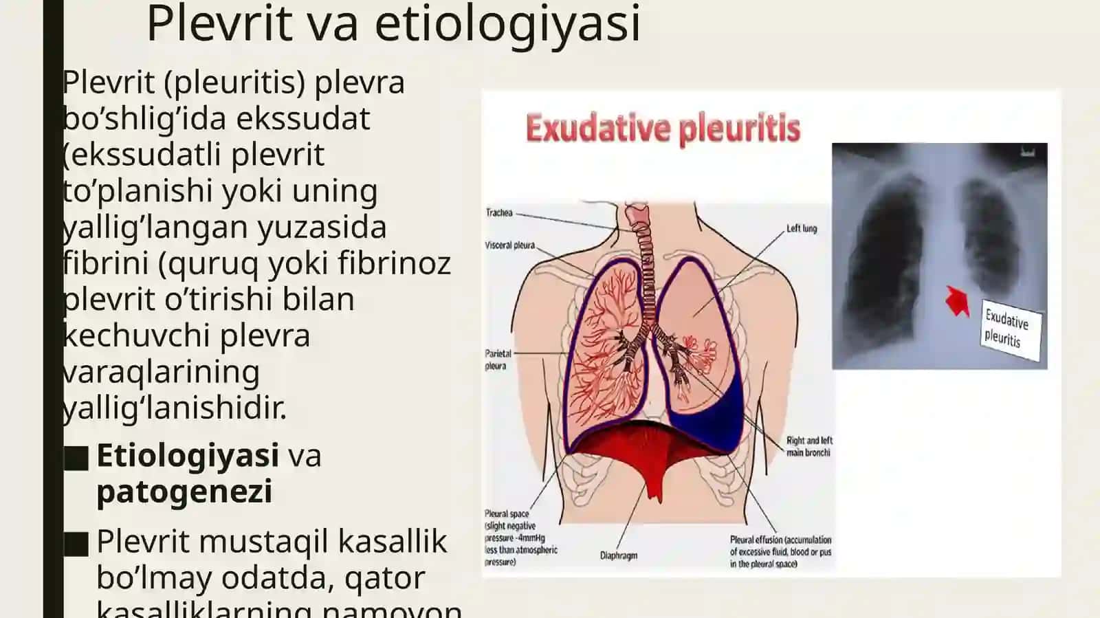 plevrit 2