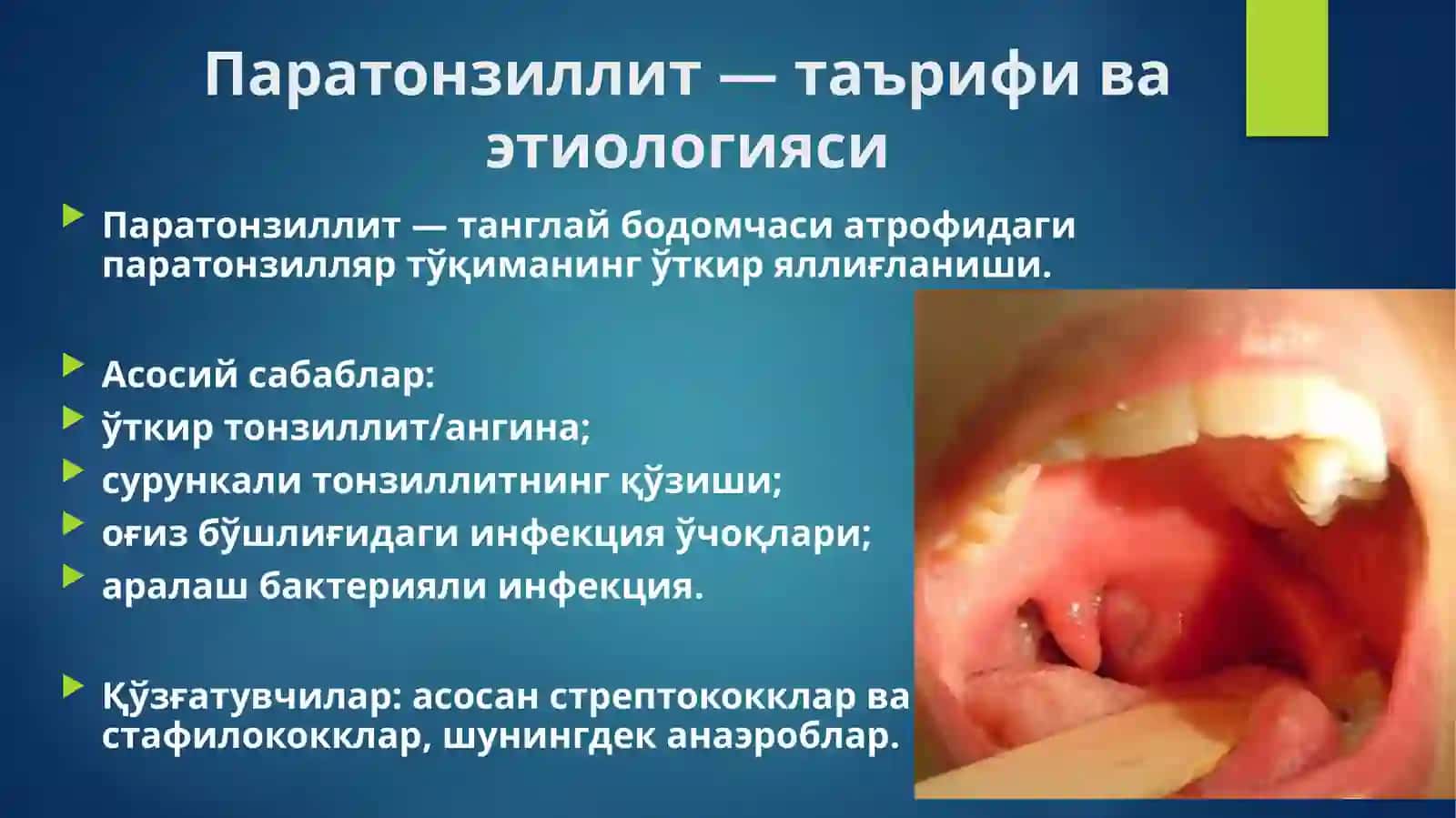Паратонзиллит ВА 8-ТИШ ПЕРИКОРОНАРИТИ 2