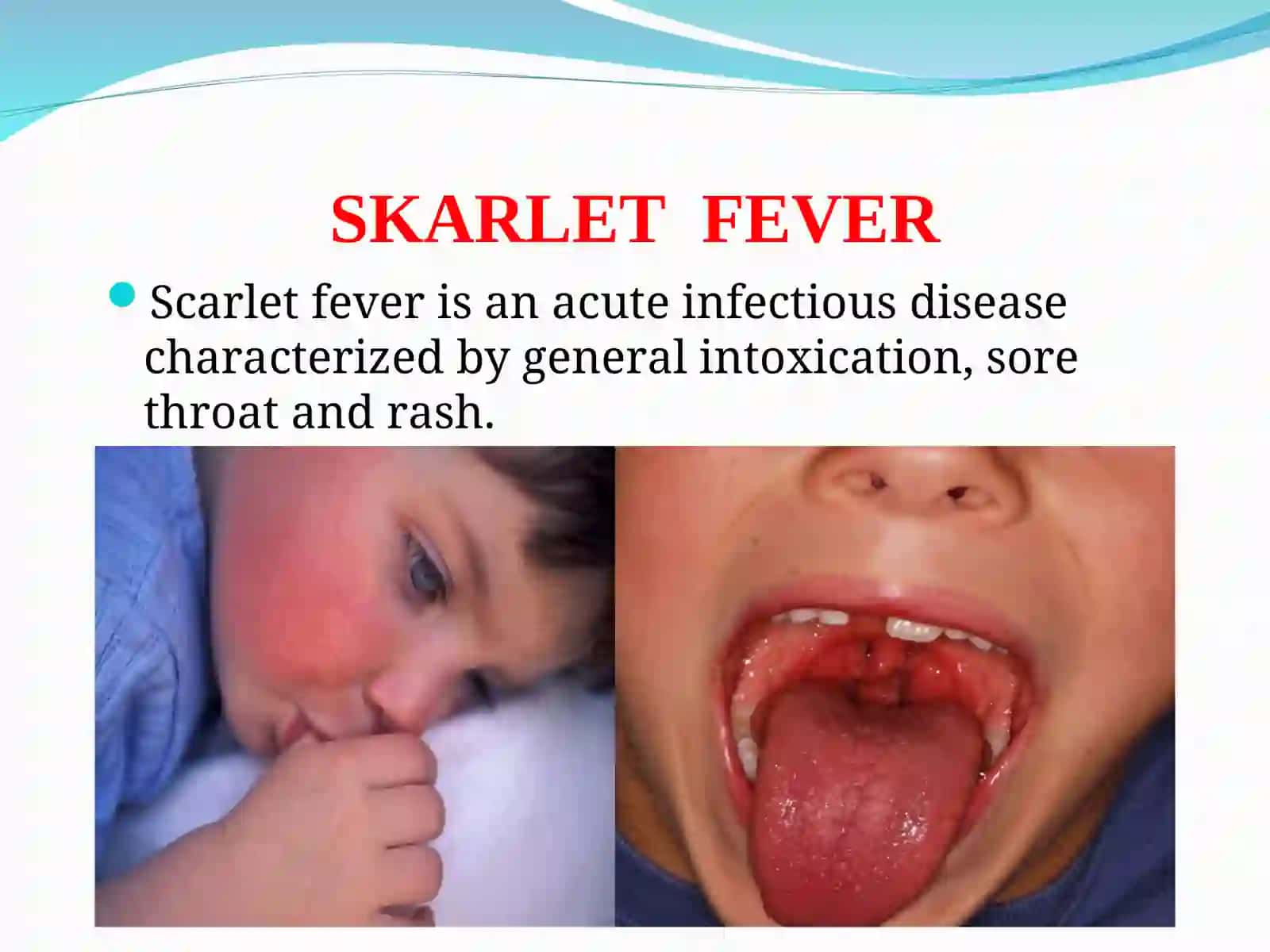 SKARLET FEVER 2