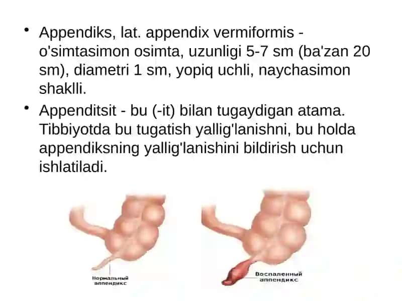 O’tkir appenditsit atipik kechishi 2