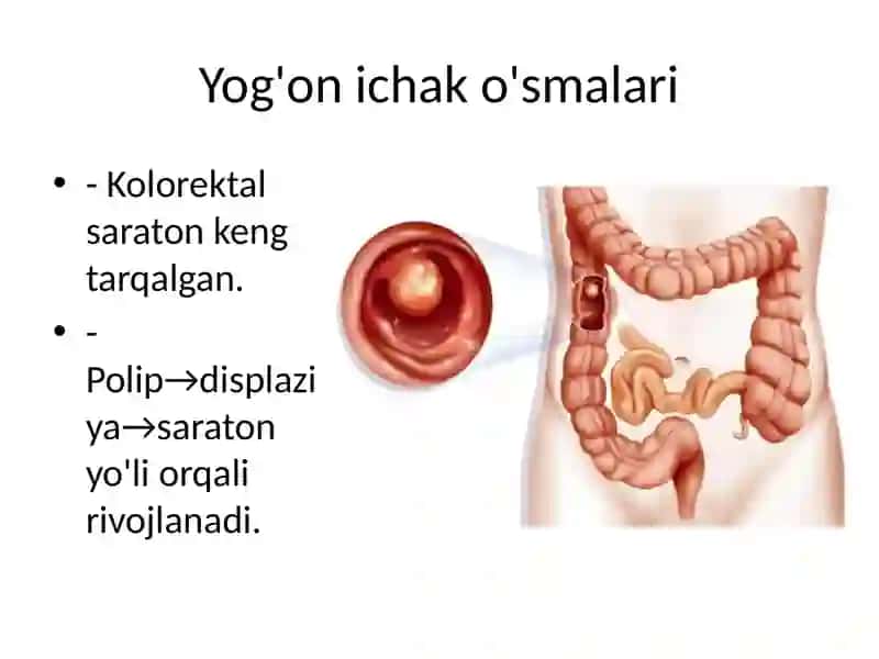 Yoʻgʻon ichak oʻsmalari 2
