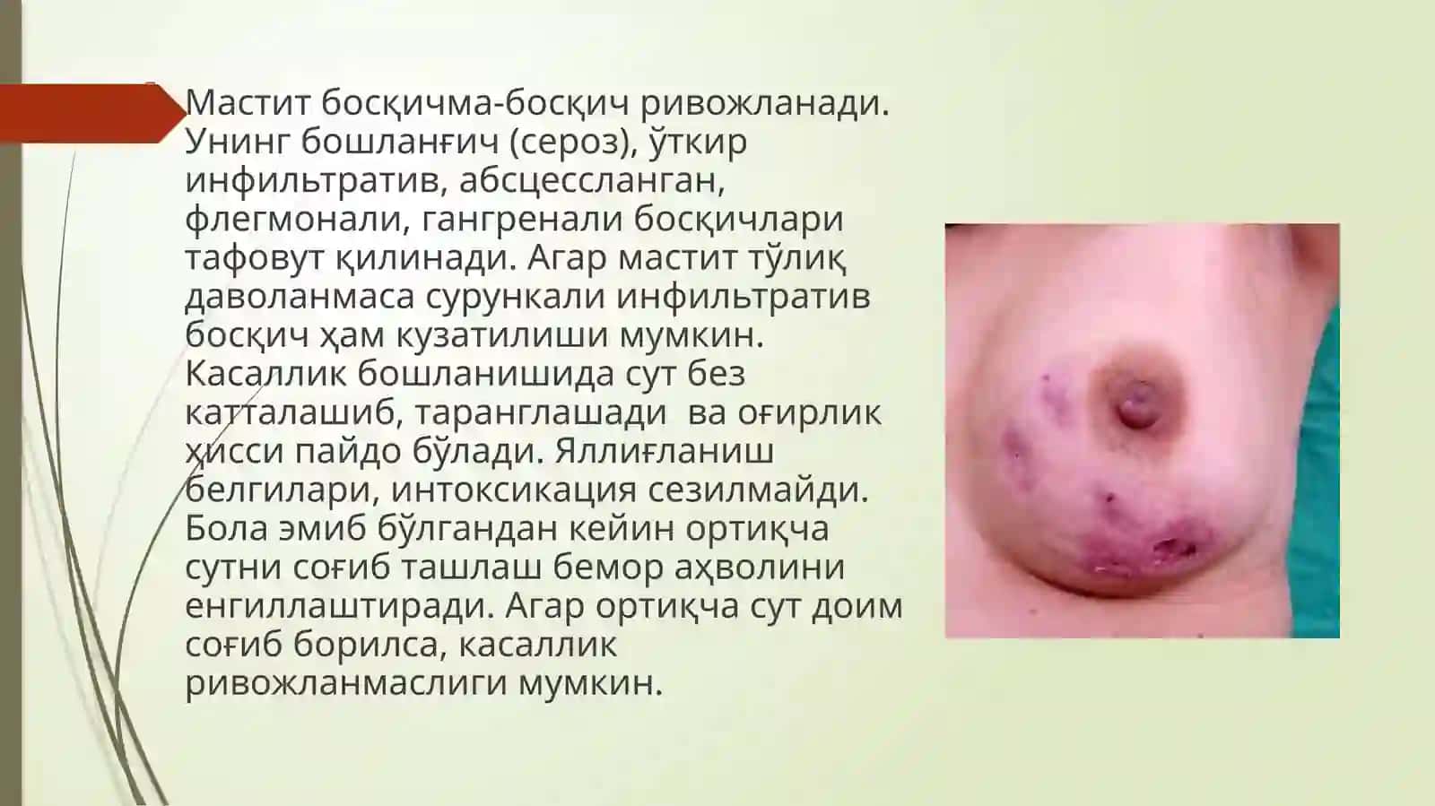 Мастит-Сутбезининг йирингли яллиғланиши 2