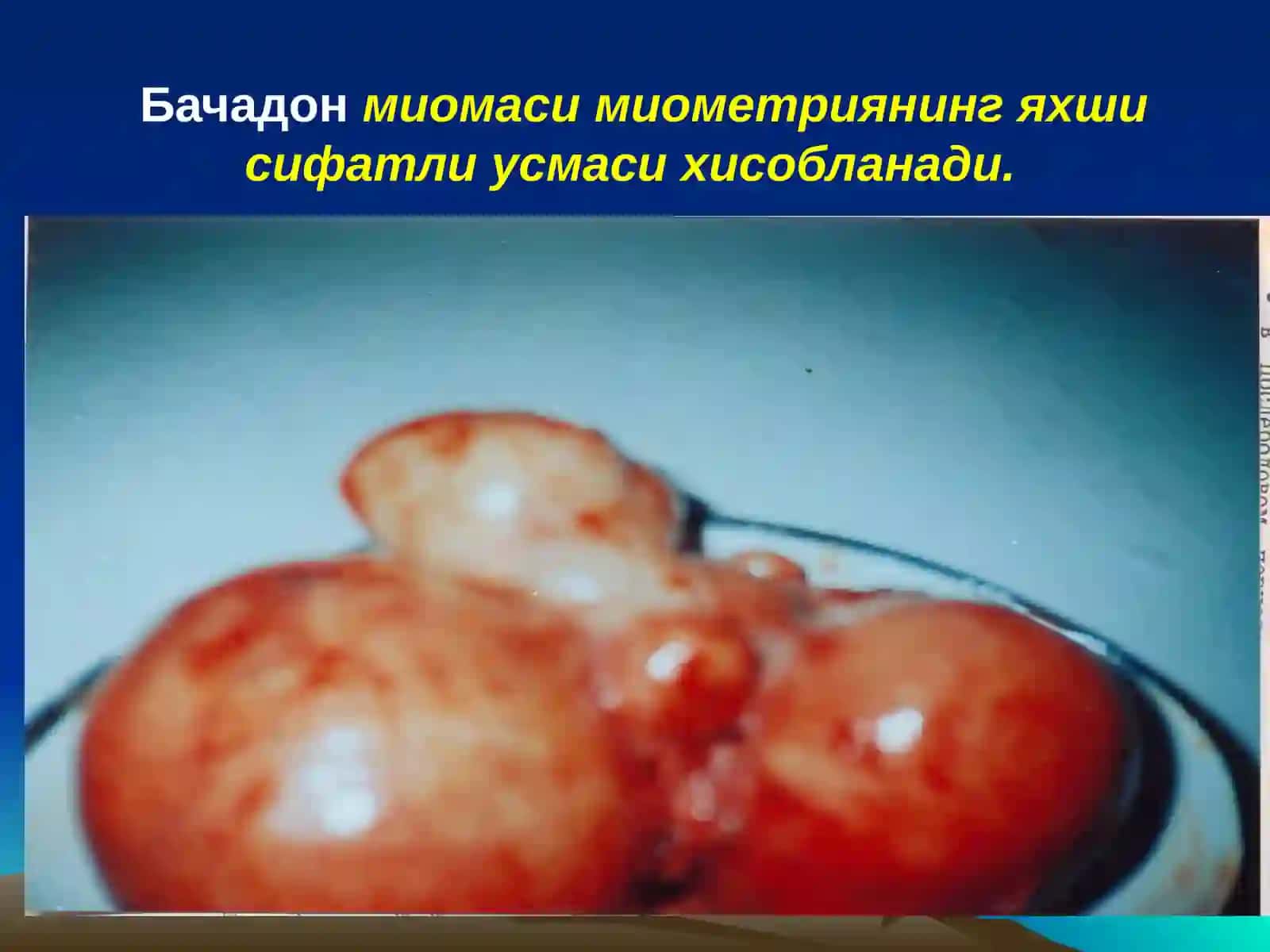 БАЧАДОН МИОМАСИ ВА ЭНДОМЕТРИОЗИ 2