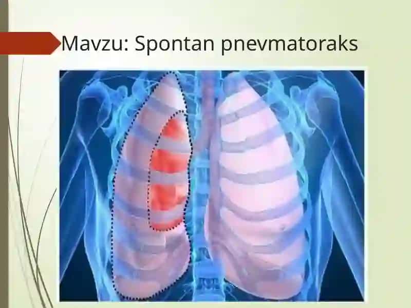 Spontanpnevmatoraks 2