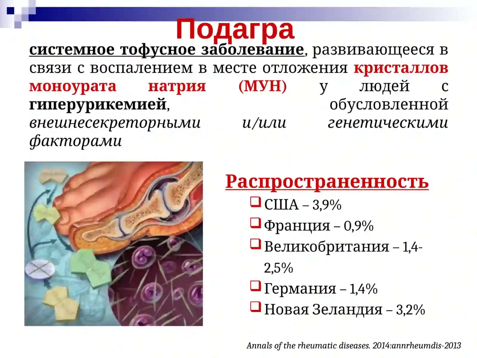 Подагра 2