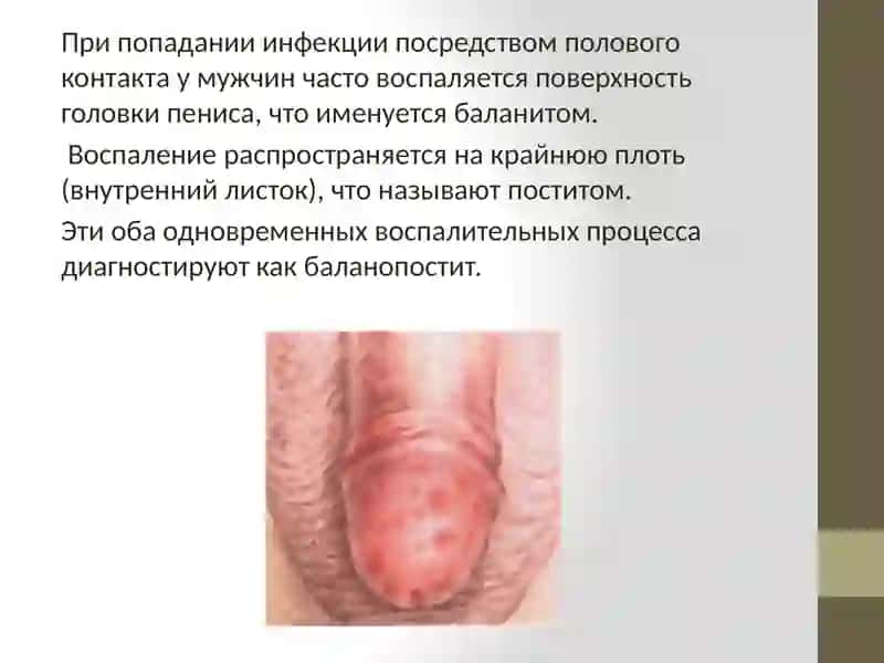 Баланопостит 2