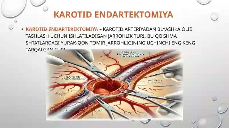 Karotidendartektomiya 2