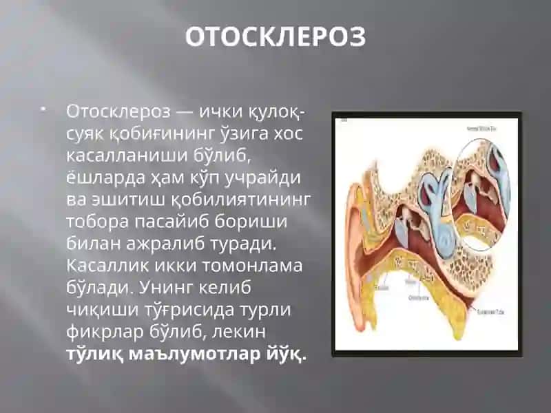 Otoskleroz 2