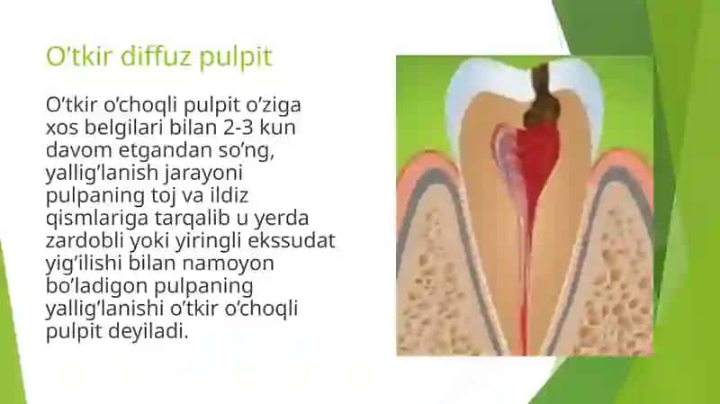 O'tkir diffuz pulpit 2