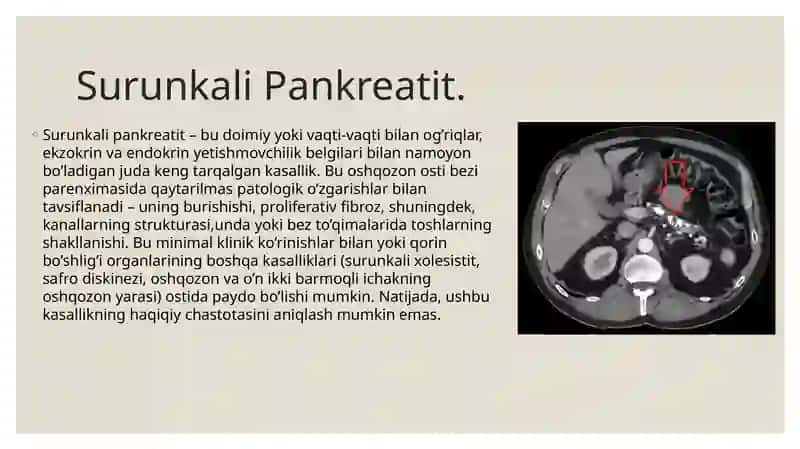 Surunkali Pankreatit 2
