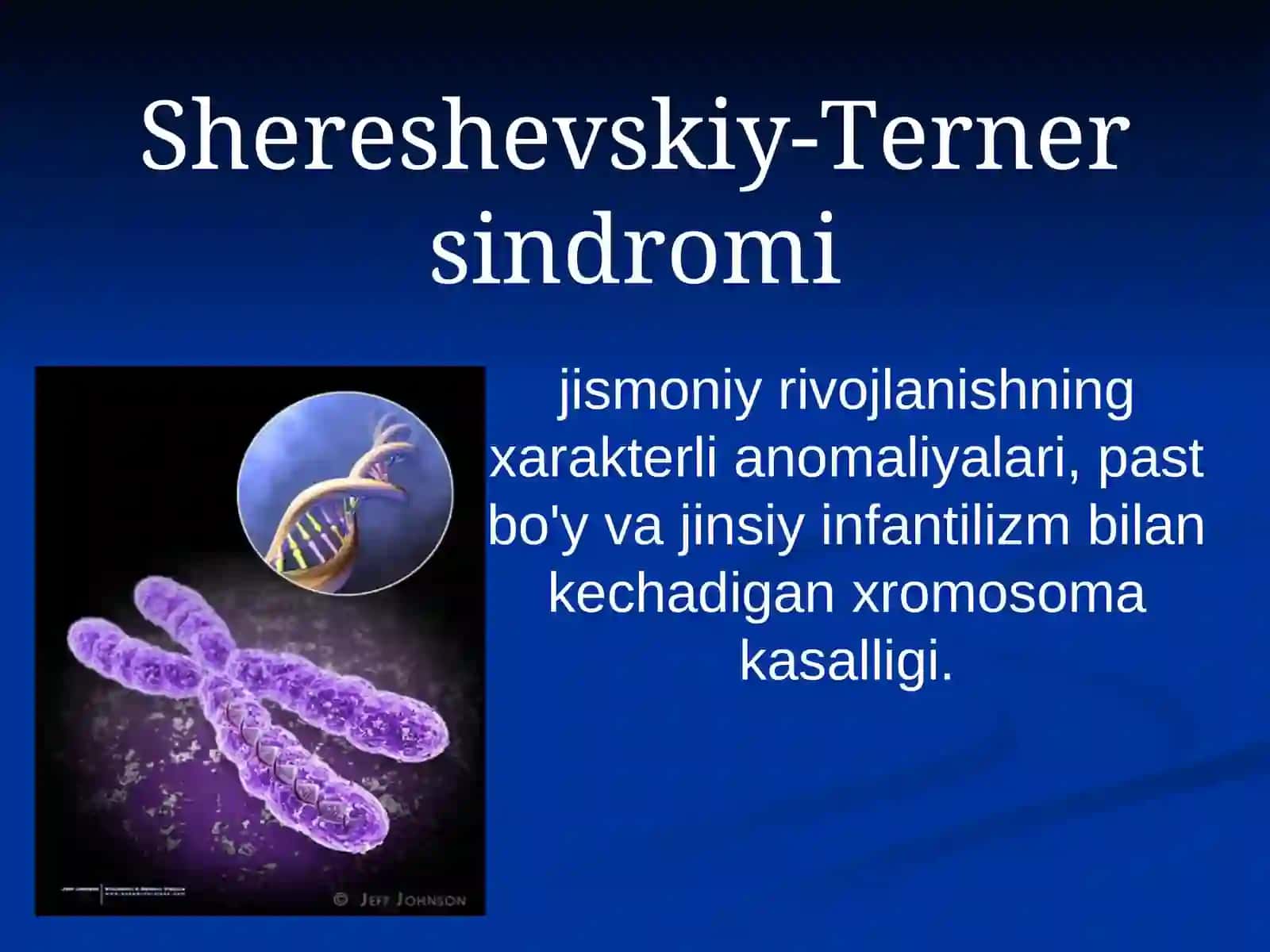 Shereshevskiy-Tеrner sindromi 2
