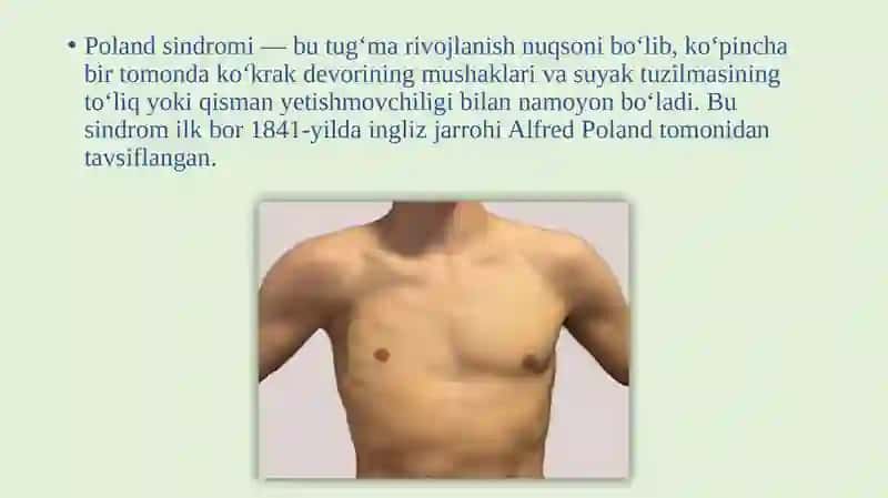 Polandsindromi 2