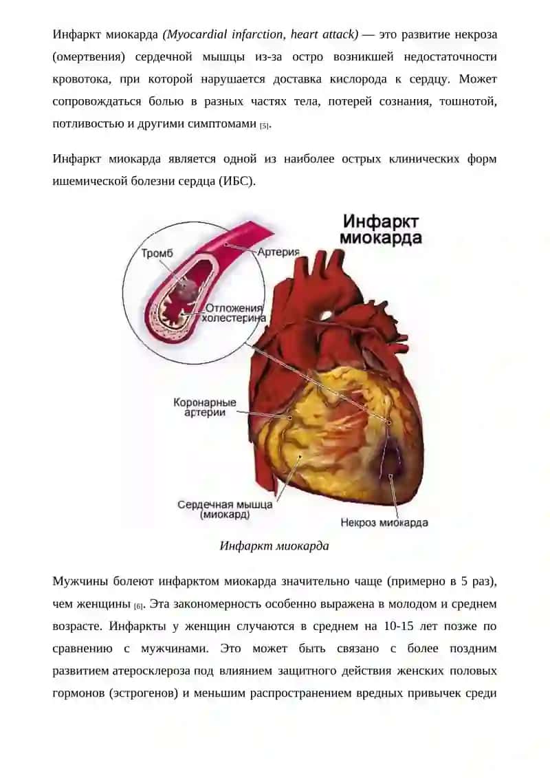 Инфаркт миокарда 2