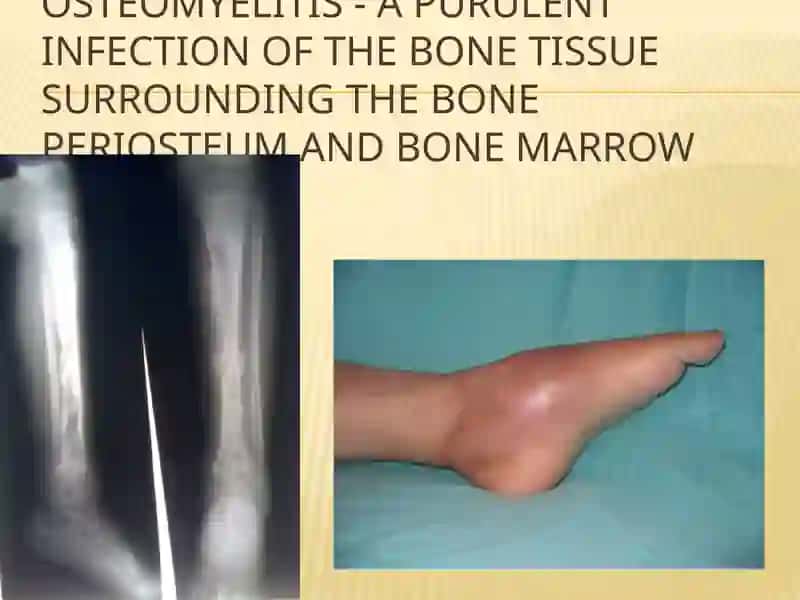 Osteomyelit 2