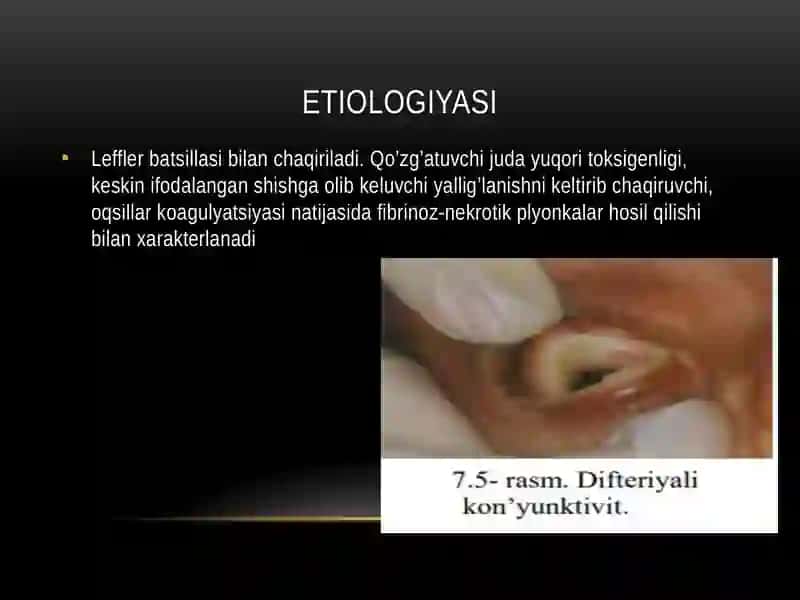 Difteriyali kon’yunktivit 2
