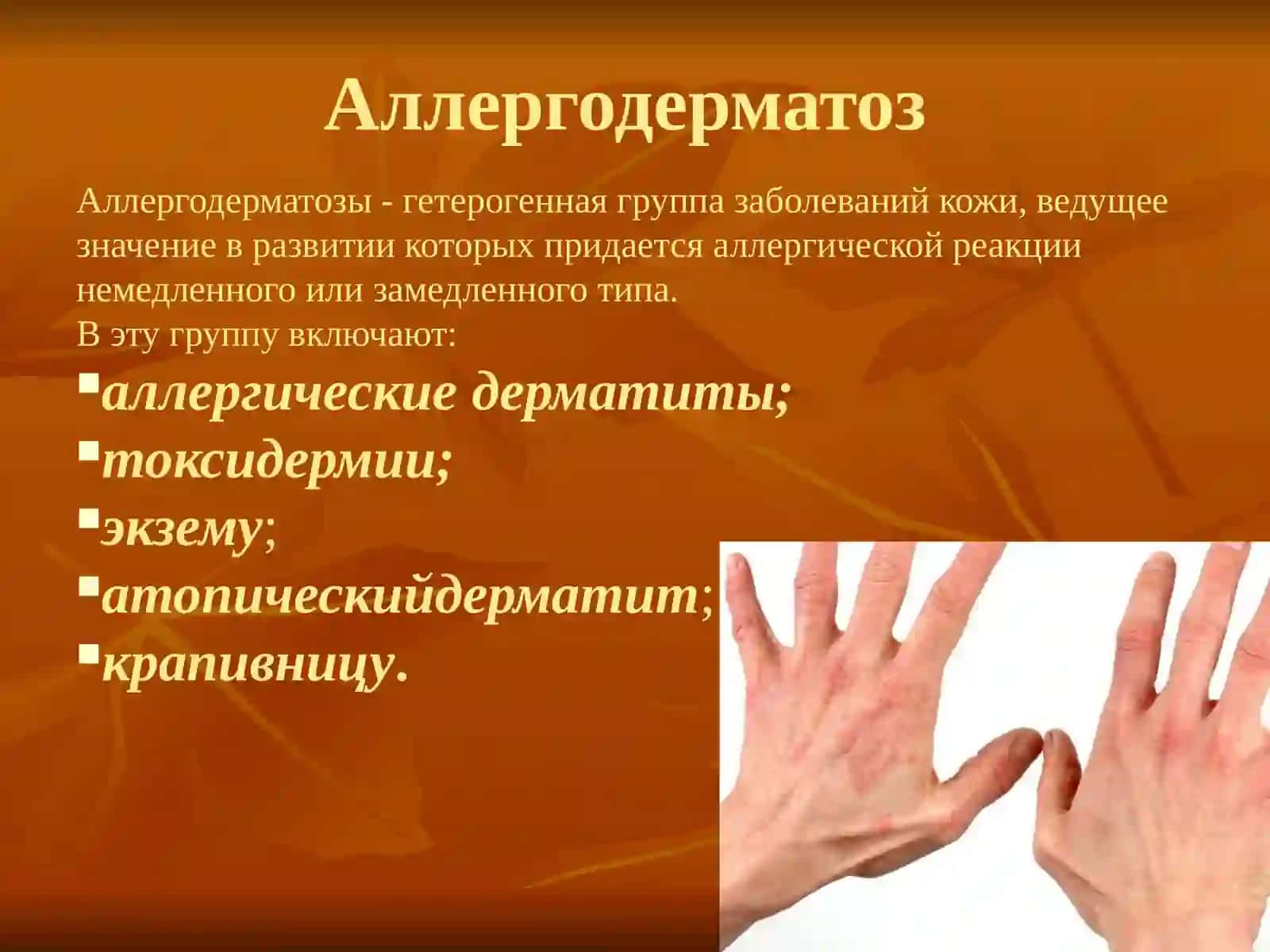 Аллергодерматозы 2