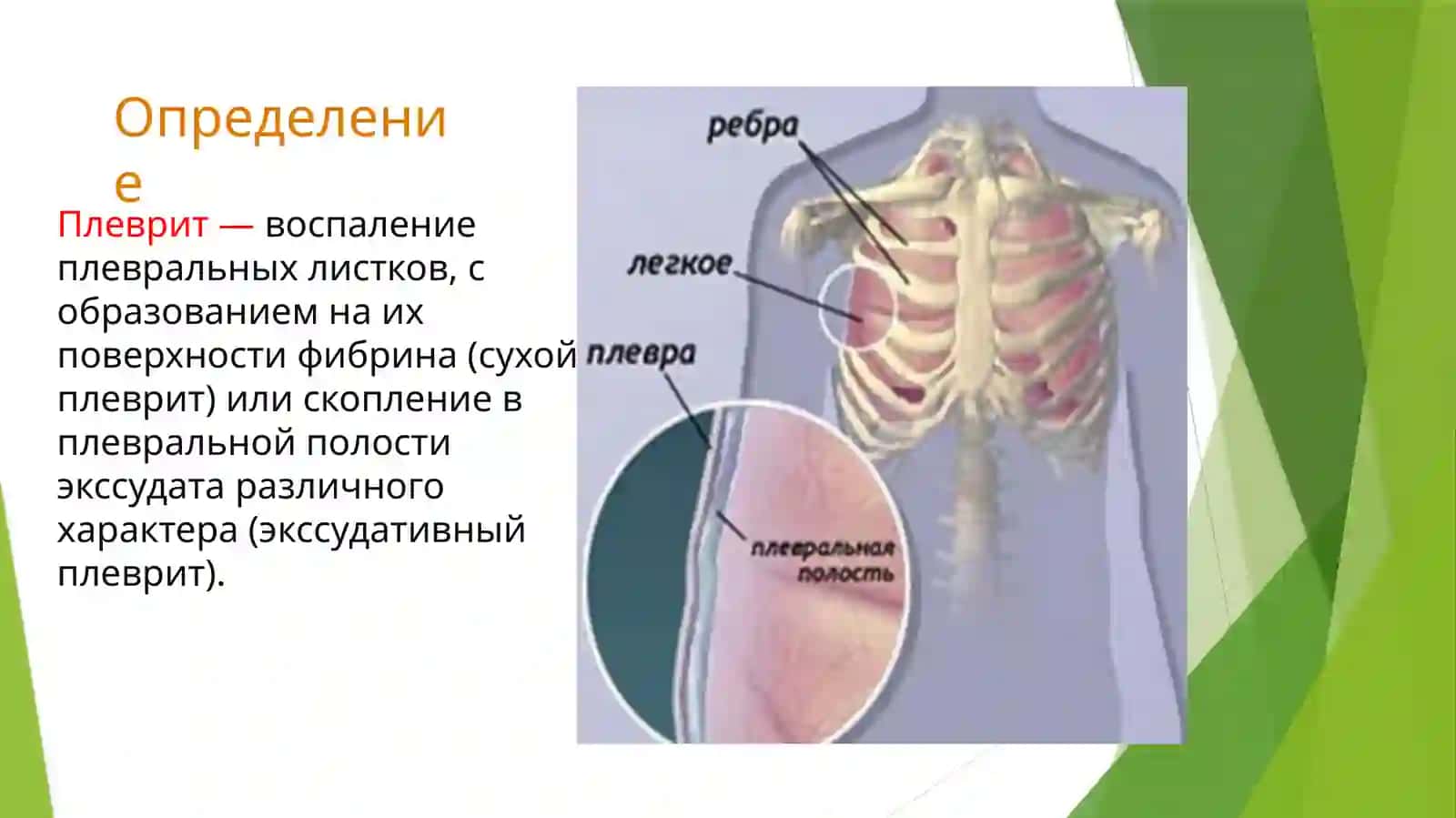 Плеврит 2
