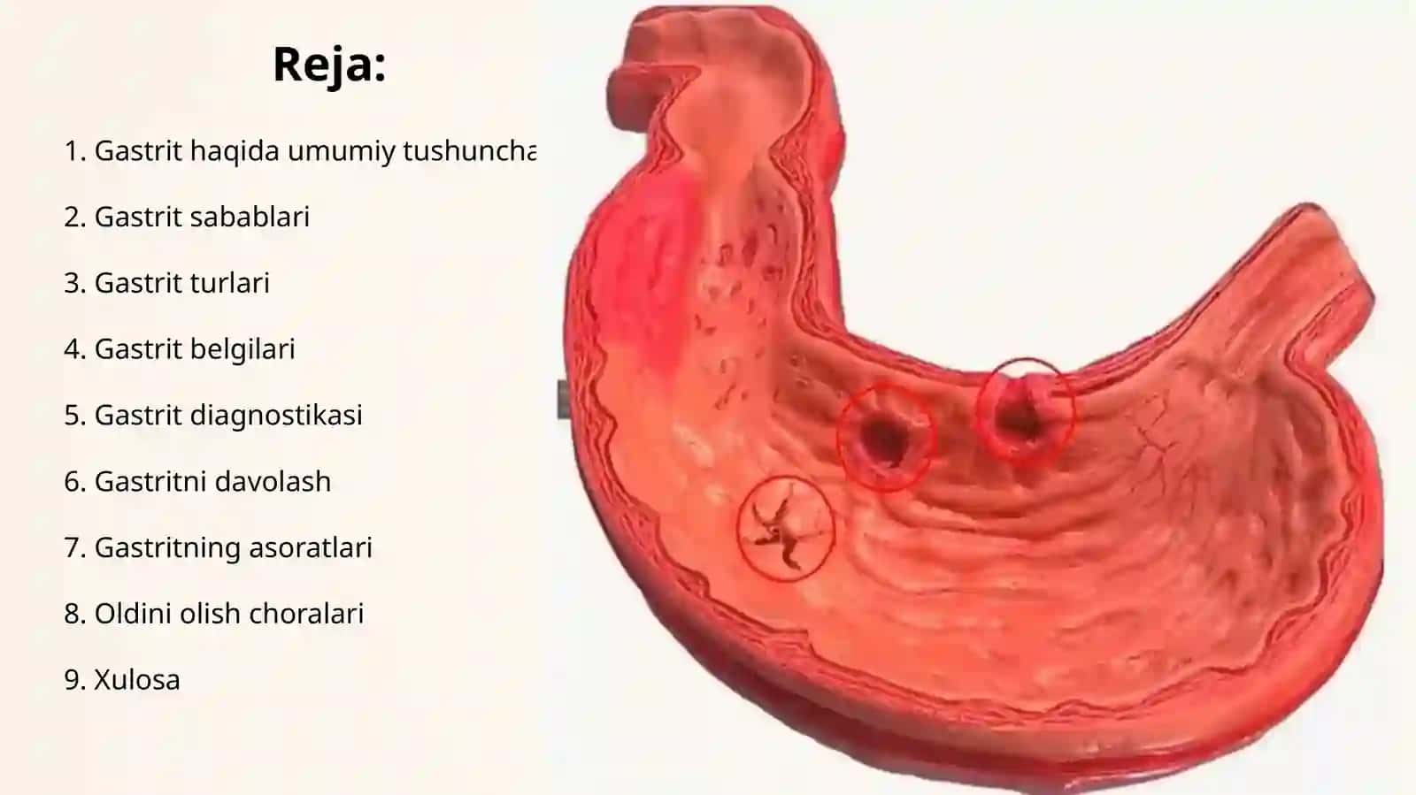 GASTRIT KASALLIGI 2