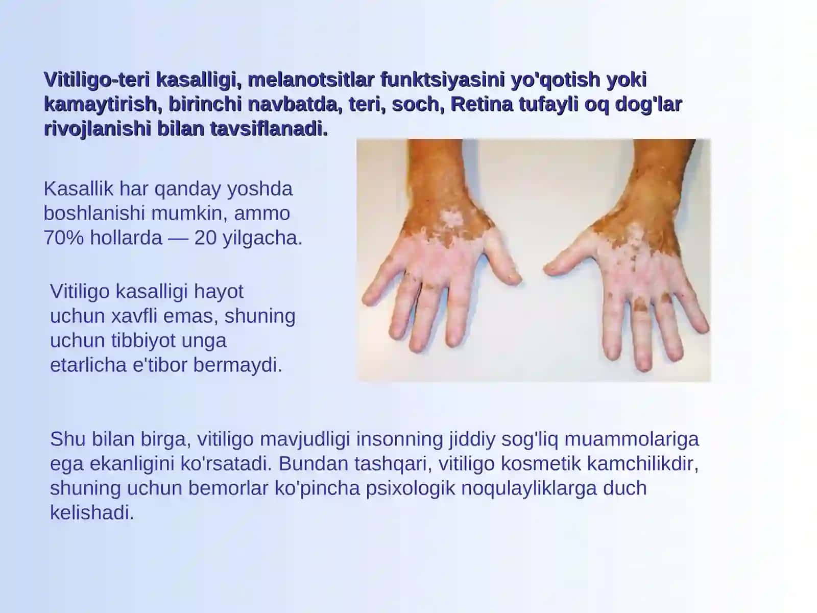Vitiligo 2