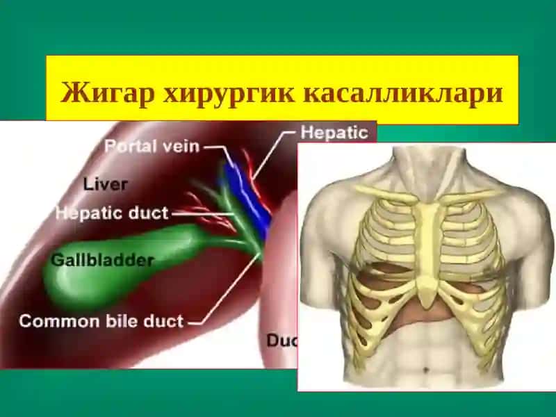 Жигар хирургик касалликлари 2