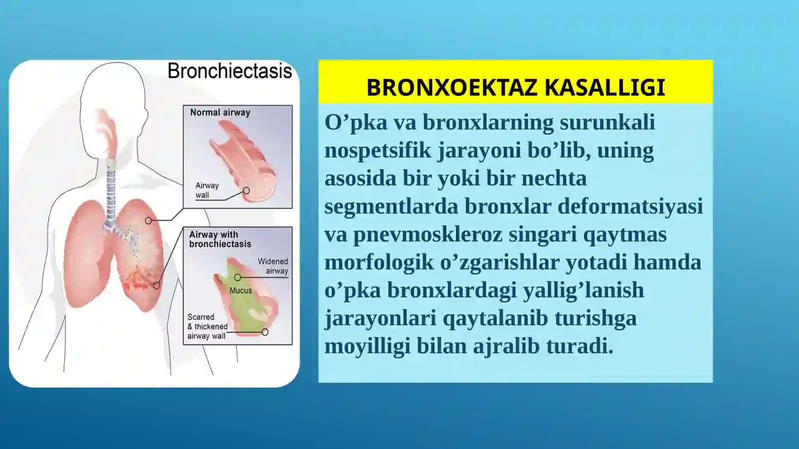 Bronxoektaz kasalligi 2
