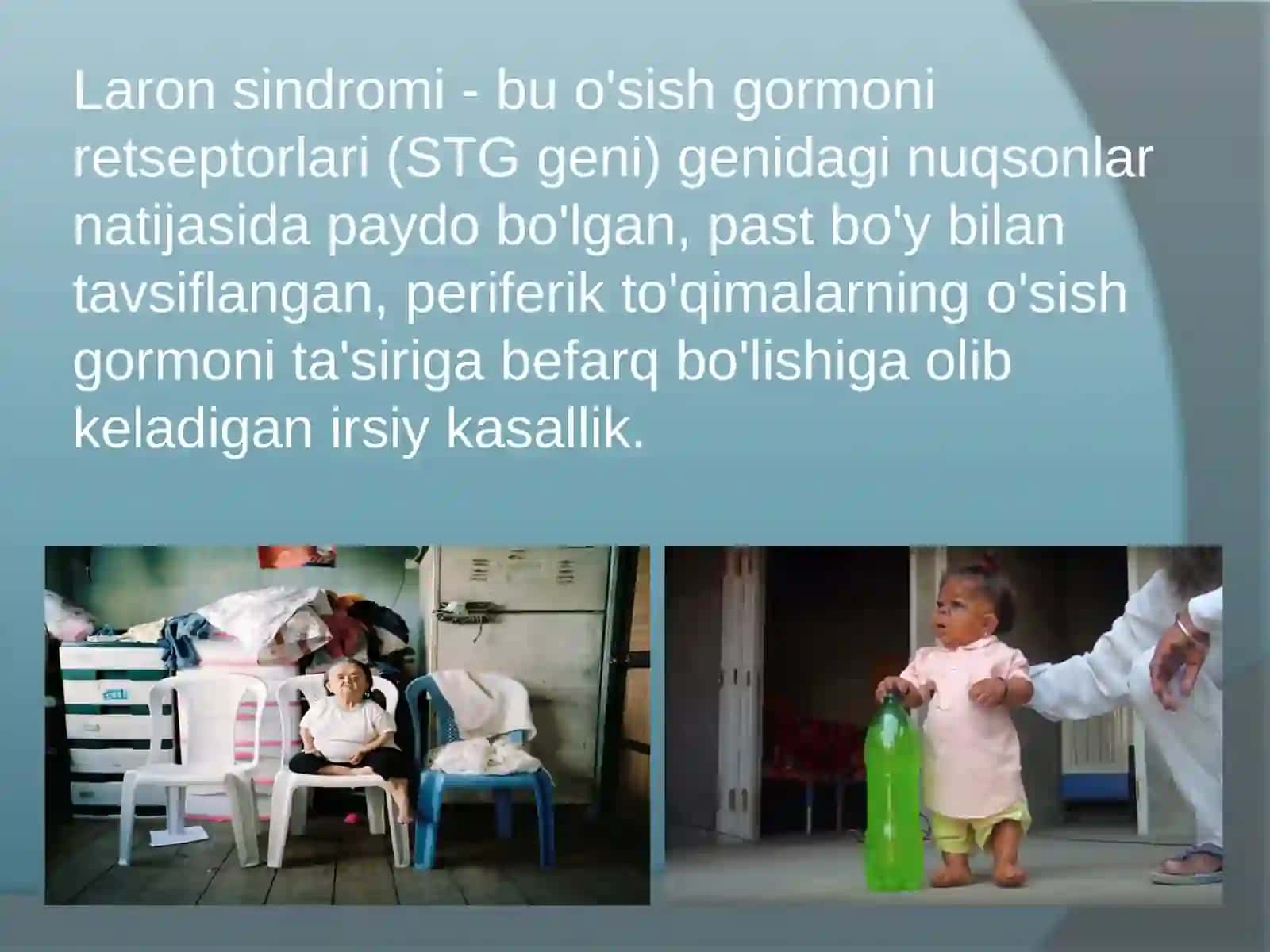 Laron sindromi 2