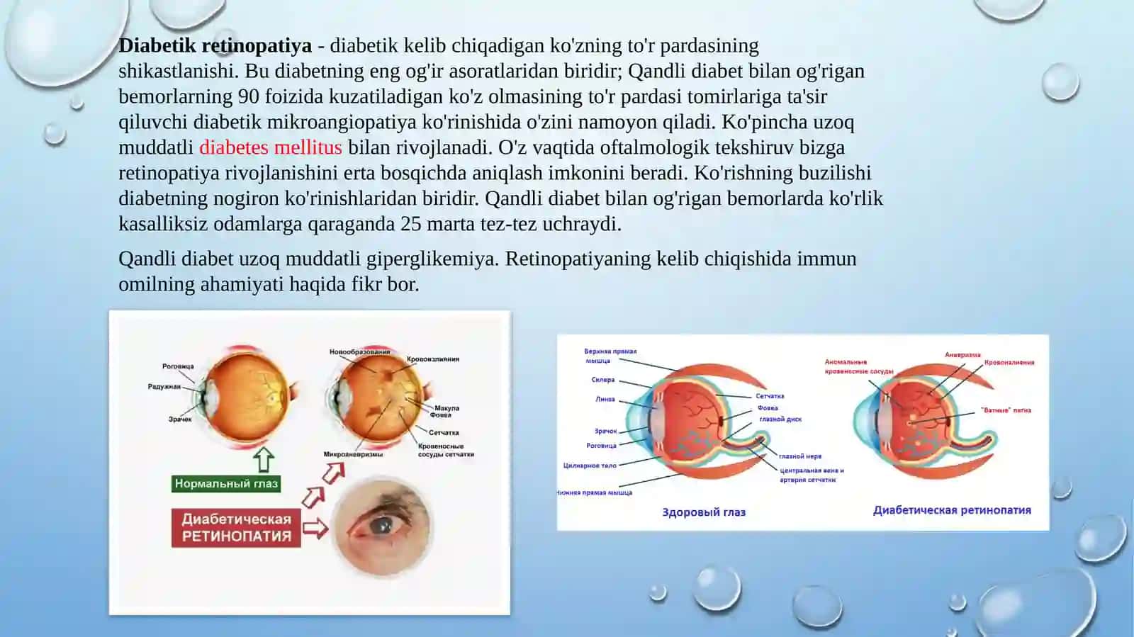 Diabetikretinopatiya 2