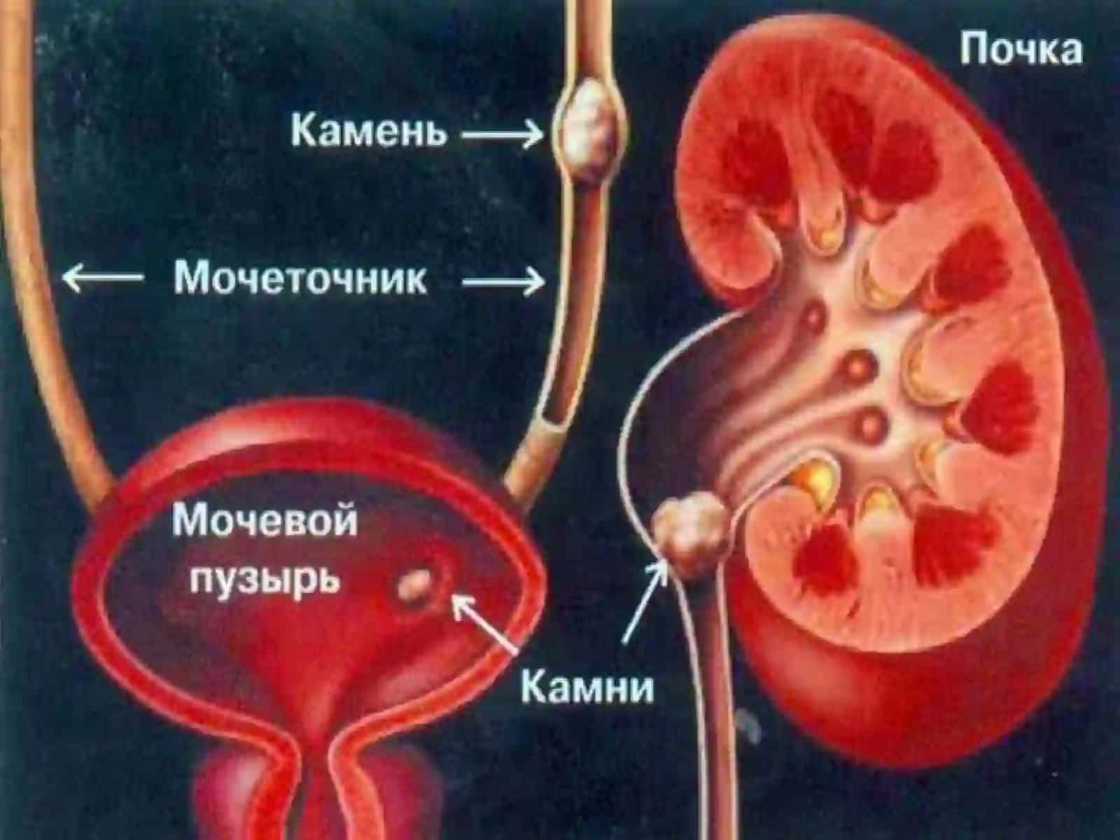 SIYDIK TOSH KASALLIGI 2
