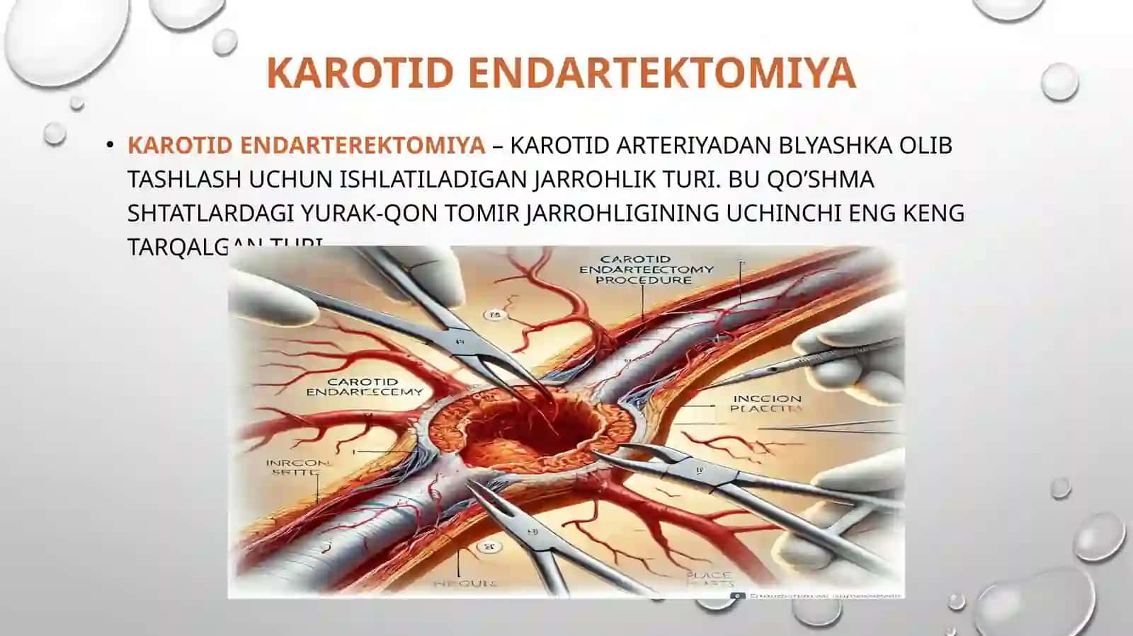 Karotidendartektomiya 2