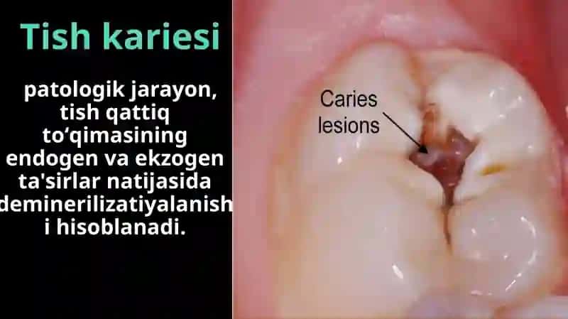 Tish kariesi 2