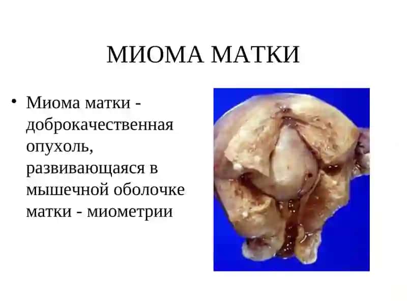 Миома матки 2