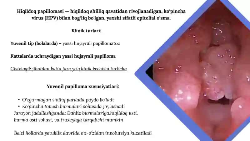 Hiqildoq papillomasi 2