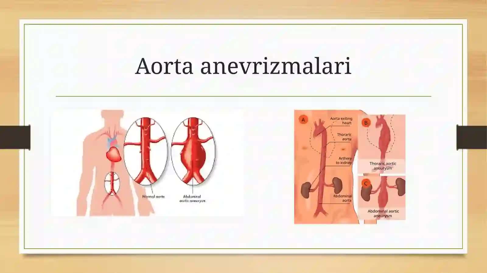 Aorta anevrizmasi 2
