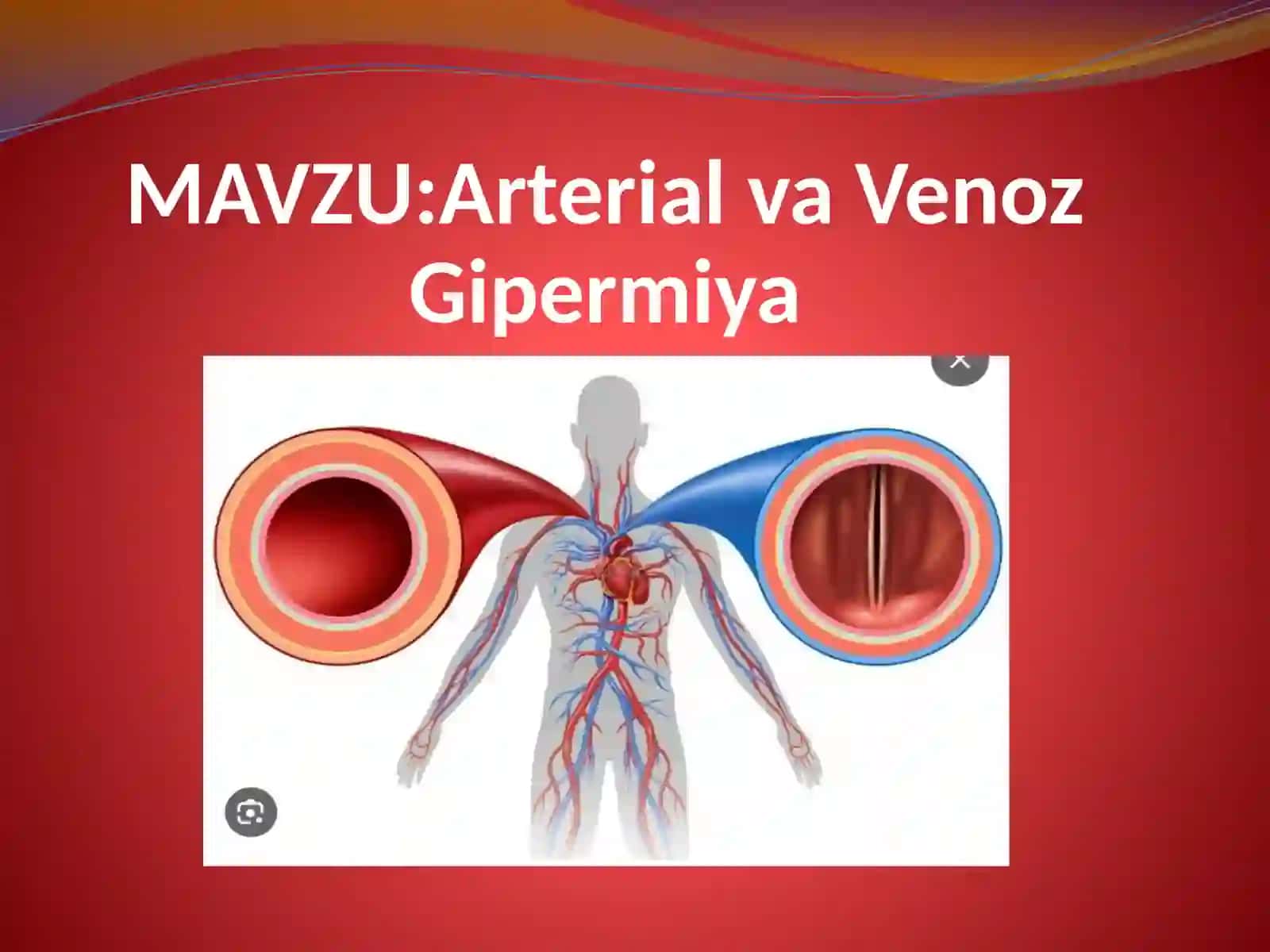 ArterialvaVenozGipermiya 2