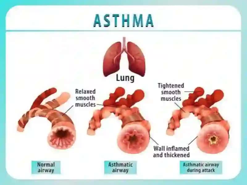Bronxialastmani zamonaviytashxislashusullari 2
