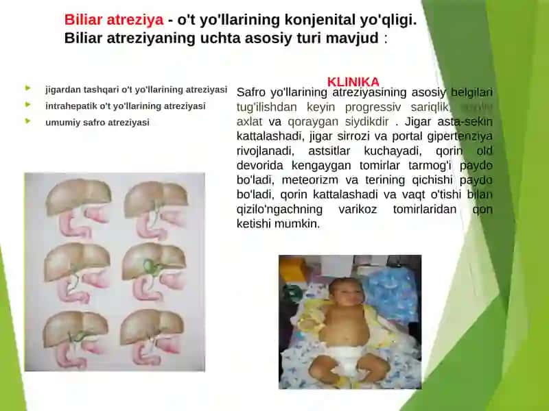 Xoletsistopatiya 2