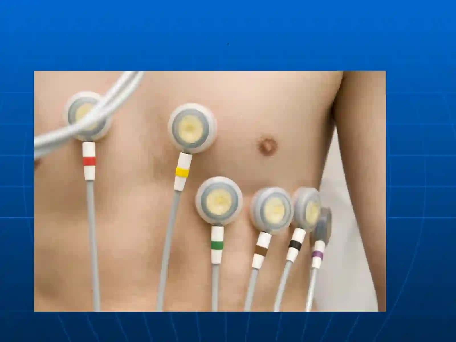 EKG va ExoKG haqida tushuncha 2