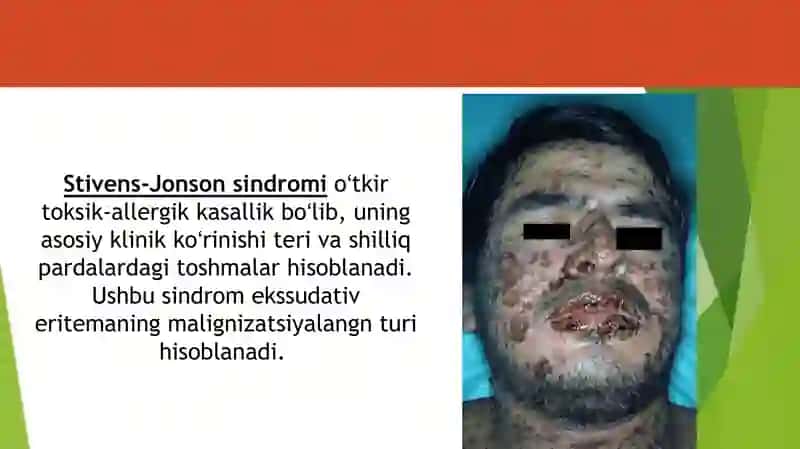 Stiven Jonson sindromi 2
