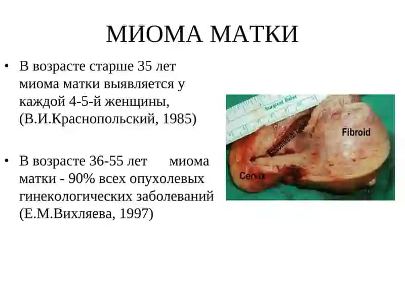 Миома матки 3