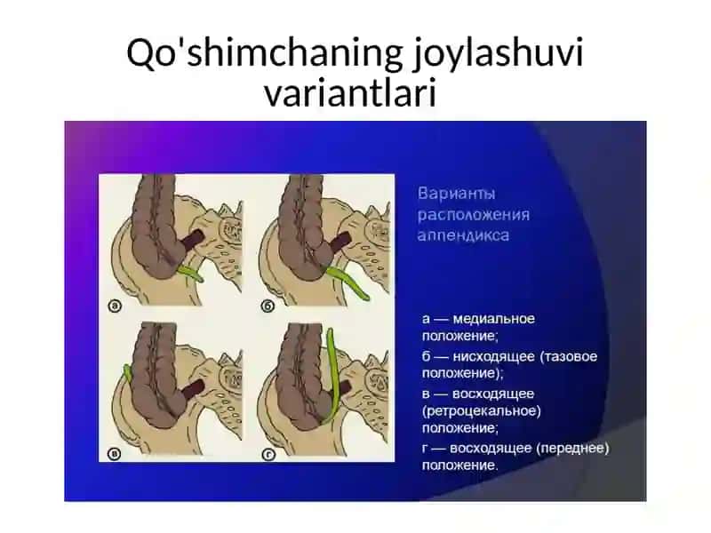 Oʻtkir appendisit atipik kechishi 3