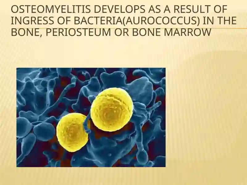 Osteomyelit 3
